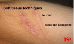 Scar Tissue Maintenance