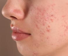 Cracking the Code on Acne: Your Guide to Clearer, Healthier Skin