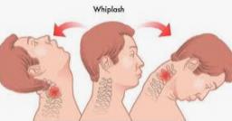 "Unraveling the Mystery of Headaches: Insights from Whiplash Specialists"