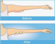How Do You Qualify for Arm Lift Surgery and What you Need to Know
