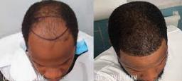 Hair Restoration and Rejuvenation