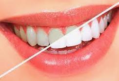 Teeth Whitening Treatments in South Africa