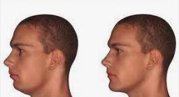 Cosmetic Surgery for Men: Recessed Chin Correction