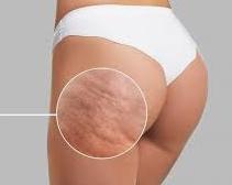 Exploring Cellulite Treatments in South Africa