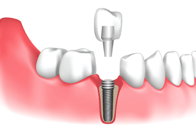 Dental Implants 101: Understanding the Procedure and Benefits