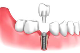 Dental Implants 101: Understanding the Procedure and Benefits