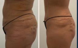 What Is Lymphatic Drainage Massage? The Science Behind Its Health and Beauty Benefits