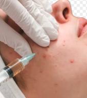 Pimple Treatments: Effective Solutions for Clear Skin