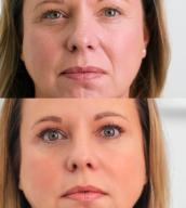 Dermal Fillers: The Secret to Youthful, Radiant Skin