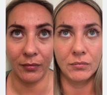 Non-Surgical Face Lifts: A Modern Beauty Revolution in South Africa