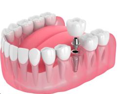 Dental Implant Removal: A Solution for Aesthetics and Comfort