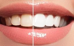 Teeth Whitening: Brightening Your Smile