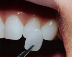 Cosmetic Dental Veneers: A Game-Changer for Your Smile