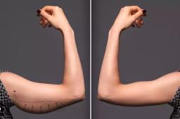 Arm Lift Surgery: The Solution for Toned, Youthful Arms