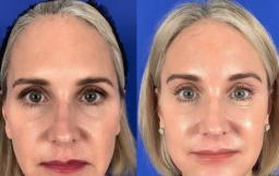 Cosmetic Surgery Brow Lift: Beauty and Confidence