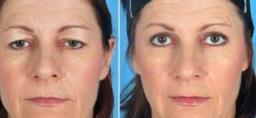 Cosmetic Surgery Eyelid Lift in South Africa: Rejuvenating Your Look