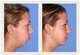 Recessed Chin Surgery: What You Need to Know