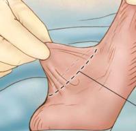 Scrotal Tuck Surgery: A Path to Confidence and Well-Being