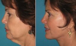 Neck Lift Surgery in South Africa: Is It Safe?