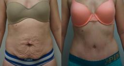 Tummy Tuck: How Far Can You Go?