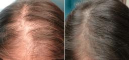 Hair Restoration and Rejuvenation: How Successful Is This Procedure?