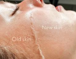 The Benefits of Dermaplaning: Is It Right for Your Skin?