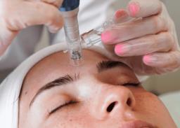Micro needling Recovery Time vs. Benefits