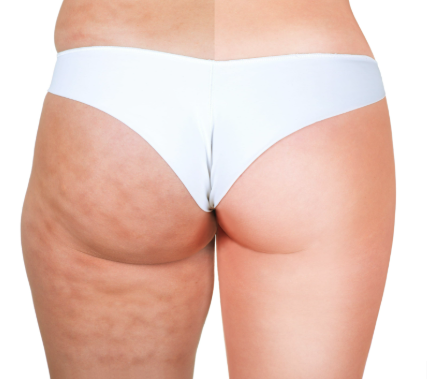 Understanding Cellulite: What It Is and Why It Happens