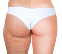 Understanding Cellulite: What It Is and Why It Happens