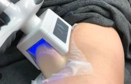 What to Expect Before, During, and After a Cryolipolysis Treatment