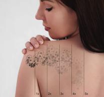 Alternative Methods of Tattoo Removal: Beyond Laser Treatments
