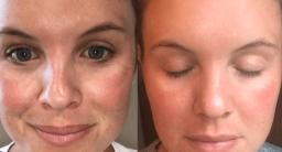 Banishing Blemishes: How Photo Rejuvenation Can Help with Acne and Scarring