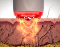 The Science Behind Multi-Polar Radio Frequency: How It Firms and Lifts Your Skin