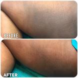Brightening with Glutathione and/or Stretch marks treatment Northcliff Non Surgical Face Lifts 11 _small