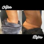 Fat Freeze, Cellulite and Varicose veins Northcliff Non Surgical Face Lifts _small