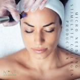 Get 20% OFF all Microneedling treatments, add on an LED treatment Northcliff Non Surgical Face Lifts 4 _small