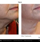 Body contouring and firming