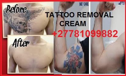 Permanent Tattoo Removal CREAM Johannesburg - Tattoo Removal - Beauty4Me
