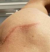 Mels Skin Clinic | Tattoo Removal | Microblading Cape Town Brackenfell Tattoo Removal 2_small