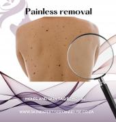 Mole and Skin tag removal