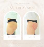 Buttocks Lift One Treatment