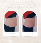 Fat Reduction on Tummy & Love Handles one Treatment