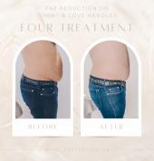 Fat Reduction on Tummy & Love Handles Four Treatment