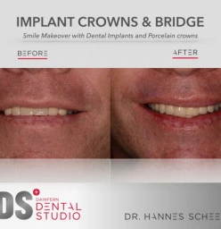 Get your new Smile Today! Dainfern Implants