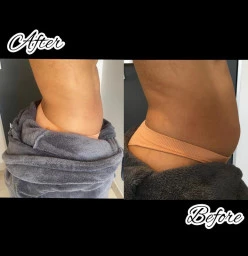 Fat Freeze, Cellulite and Varicose veins Northcliff Non Surgical Face Lifts