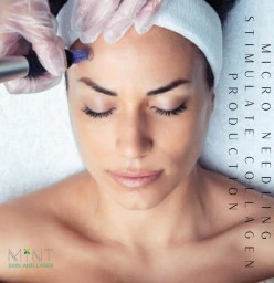Get 20% OFF all Microneedling treatments, add on an LED treatment Northcliff Non Surgical Face Lifts